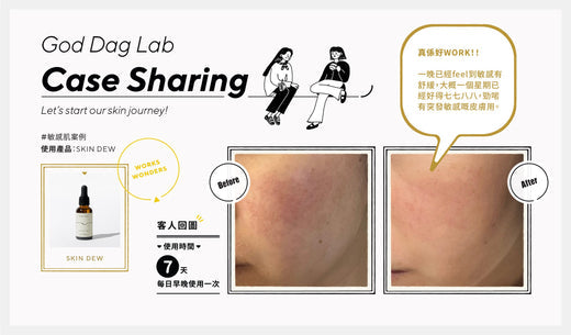 【用家分享】敏感肌案例